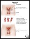 Thumbnail image of: Vasectomy: Illustration