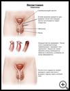 Thumbnail image of: Vasectomy: Illustration