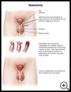 Thumbnail image of: Vasectomy: Illustration