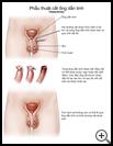 Thumbnail image of: Vasectomy: Illustration