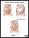 Thumbnail image of: Breech Position--Turning the Baby: Illustration