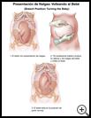 Thumbnail image of: Breech Position--Turning the Baby: Illustration