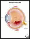 Thumbnail image of: Vitreous Hemorrhage: Illustration