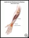 Thumbnail image of: Wrist Tendon Injury: Illustration