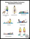 Thumbnail image of: Bruised Knee (Patellar Contusion) Exercises: Illustration, page 1