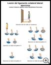 Thumbnail image of: Lateral Collateral Ligament Sprain Exercises: Illustration, page 2