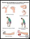Thumbnail image of: Wrist Fracture, Scaphoid, Exercises: Illustration, Page 1