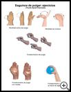 Thumbnail image of: Thumb Sprain Exercises: Illustration