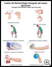 Thumbnail image of: Triangular Fibrocartilage Complex (TFCC) Injury Exercises: Illustration