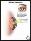 Thumbnail image of: YAG Laser Capsulotomy: Illustration