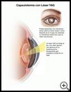 Thumbnail image of: YAG Laser Capsulotomy: Illustration