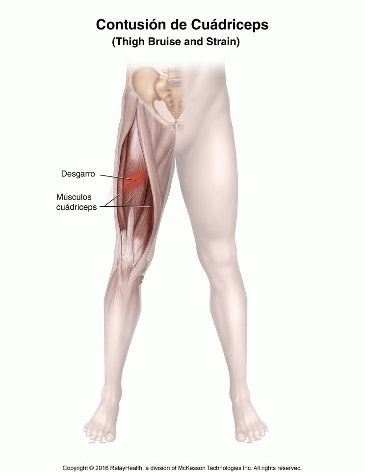 Thigh Bruise and Strain (Quadriceps Contusion): Illustration