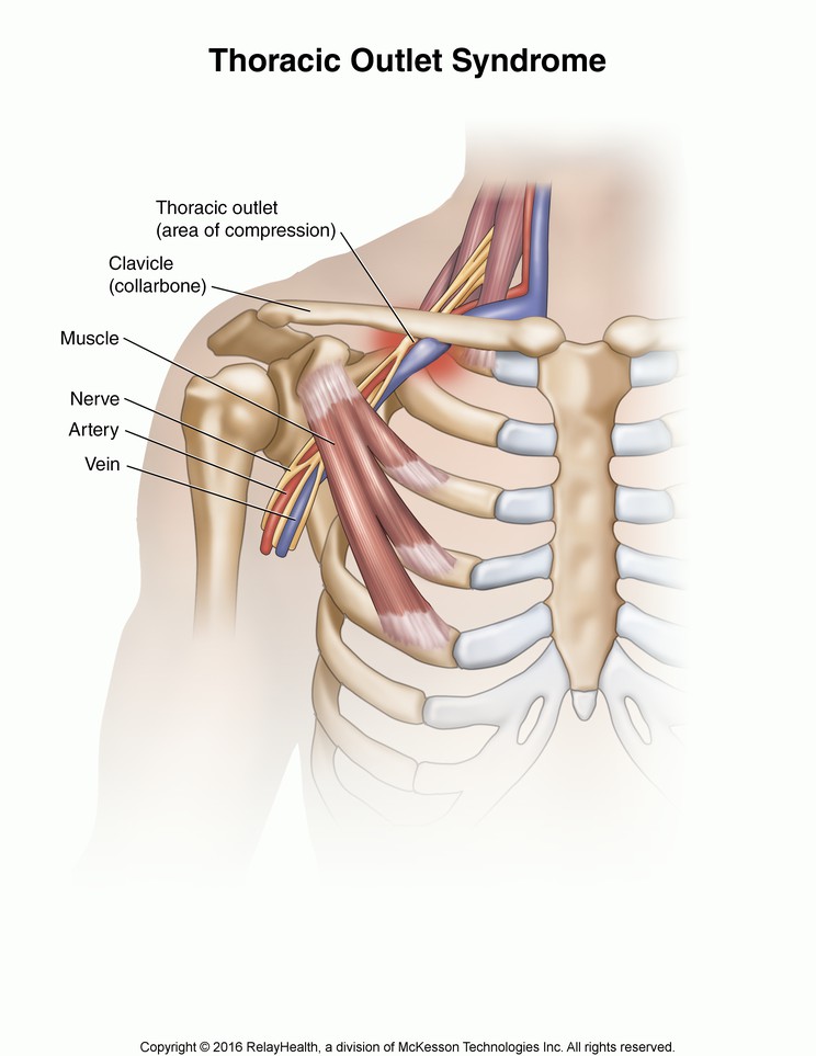 Thoracic Outlet Syndrome: Illustration