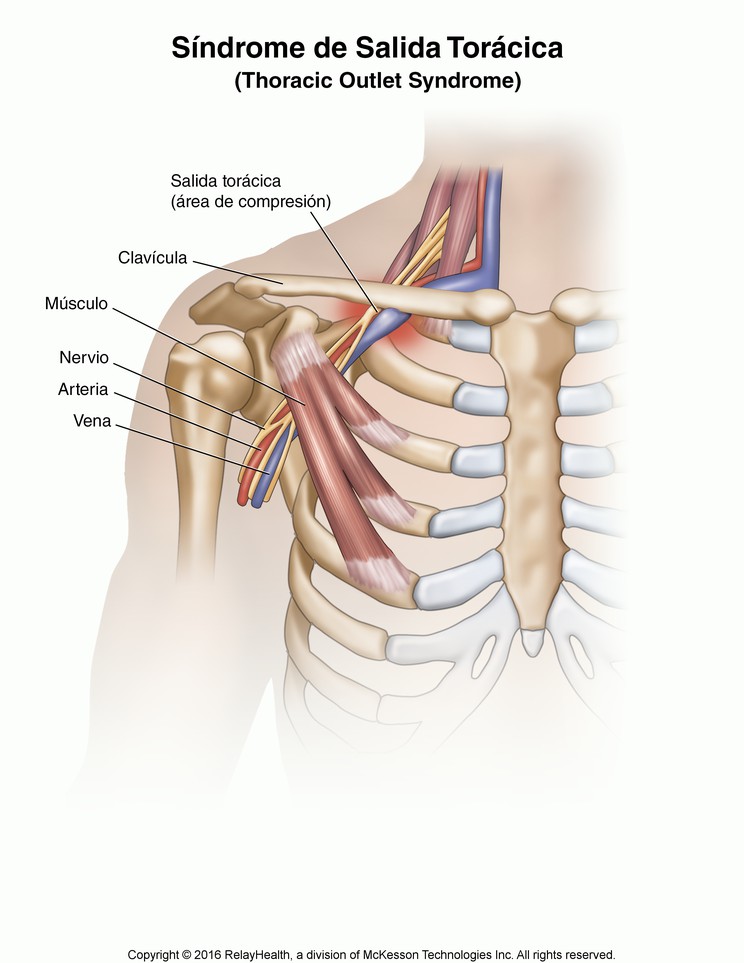 Thoracic Outlet Syndrome: Illustration
