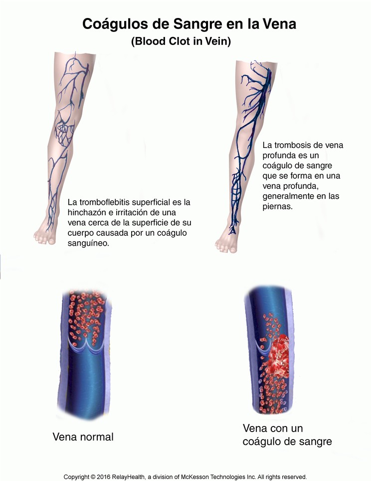 Blood Clot in Vein: Illustration