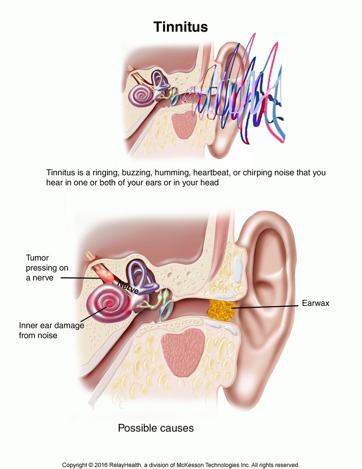 Tinnitus: Illustration