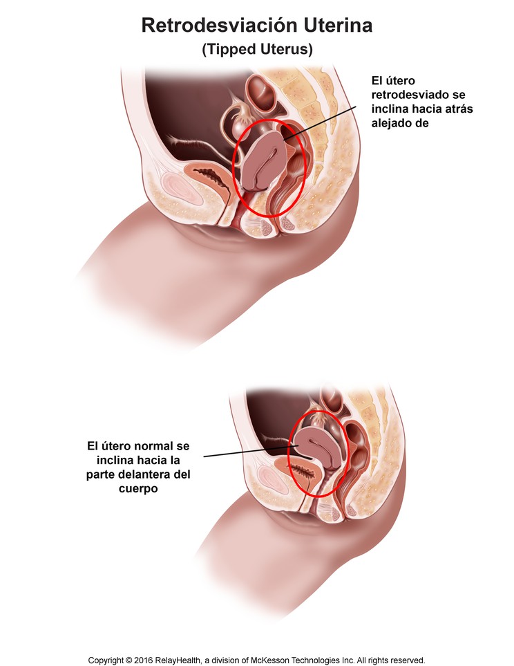 Tipped Uterus: Illustration