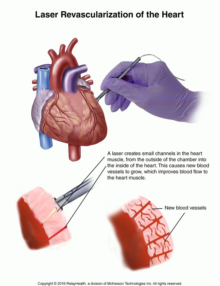 Laser Revascularization of the Heart: Illustration