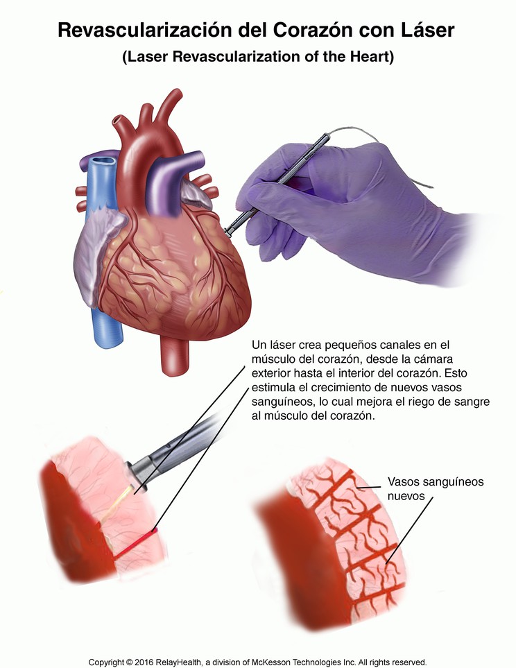 Laser Revascularization of the Heart: Illustration