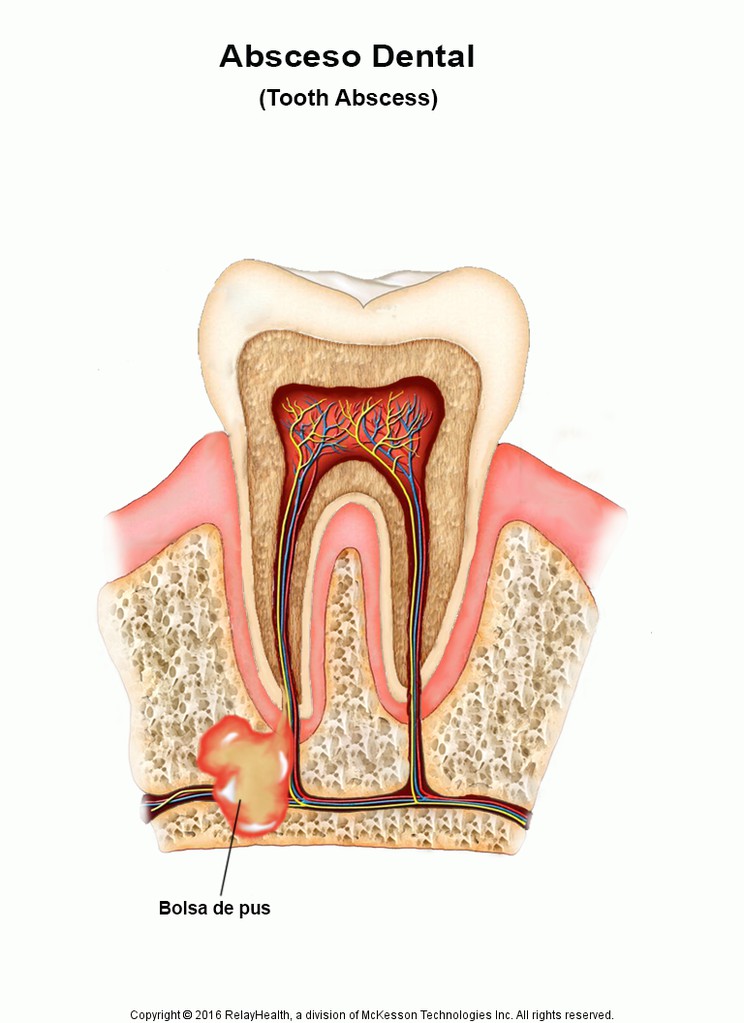 Tooth Abscess: Illustration