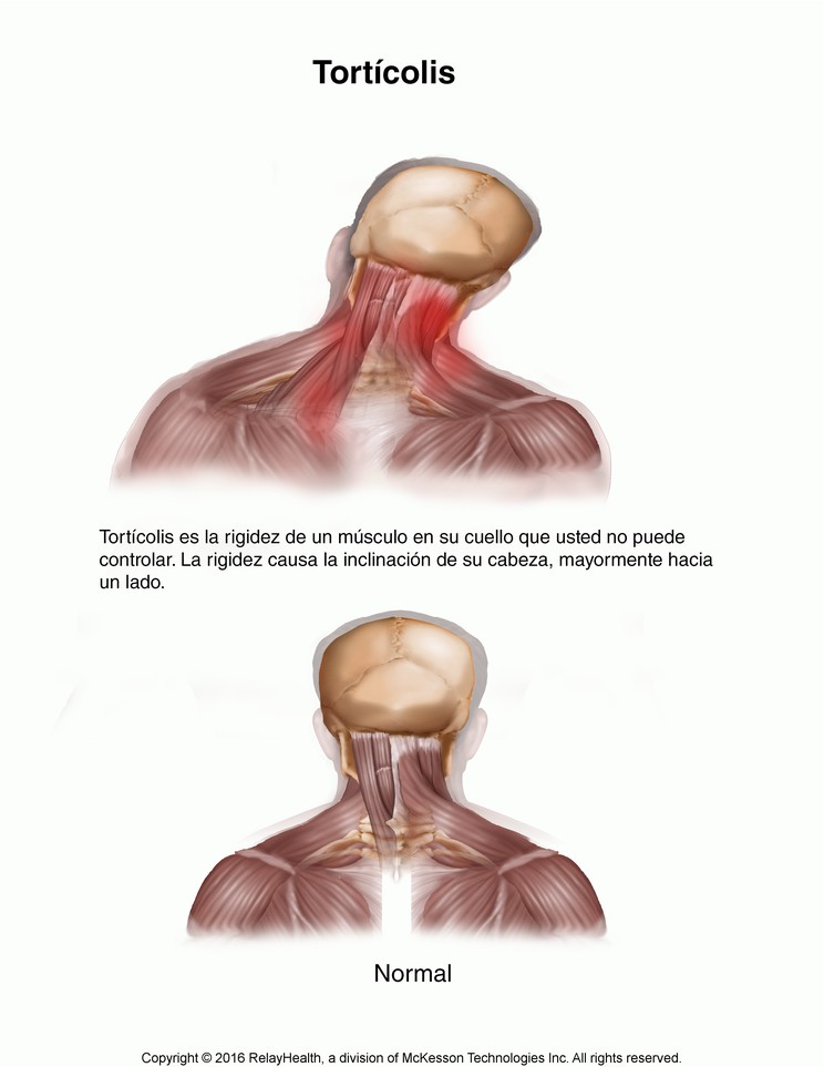 Torticollis: Illustration