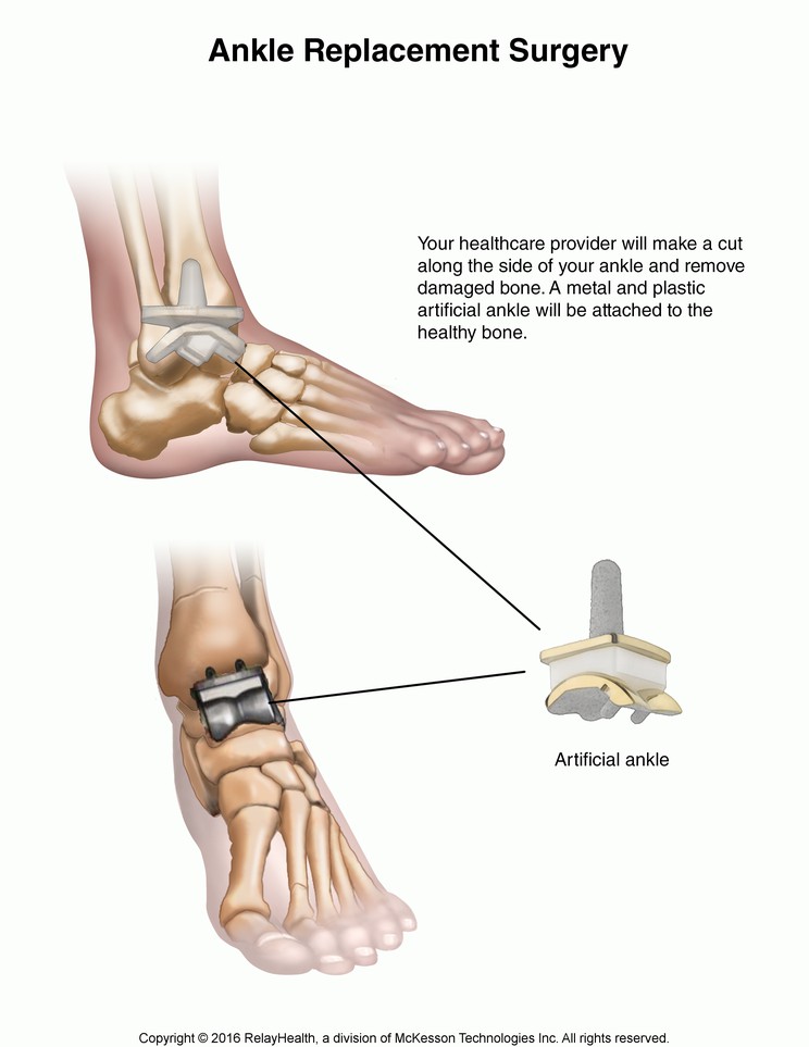 Ankle Replacement Surgery: Illustration