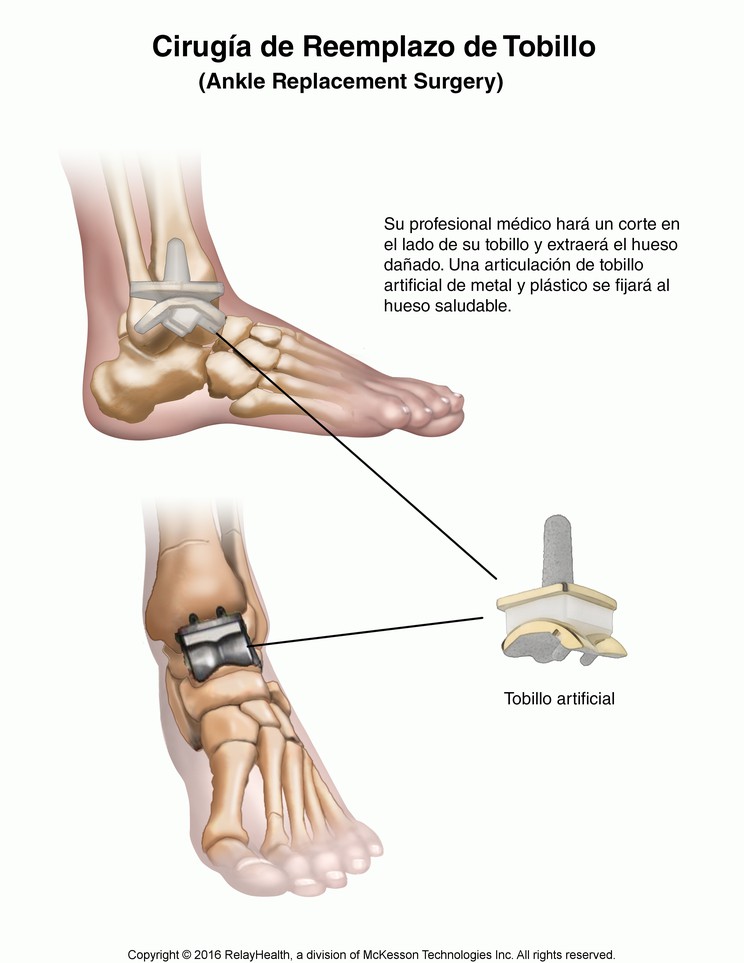Ankle Replacement Surgery: Illustration