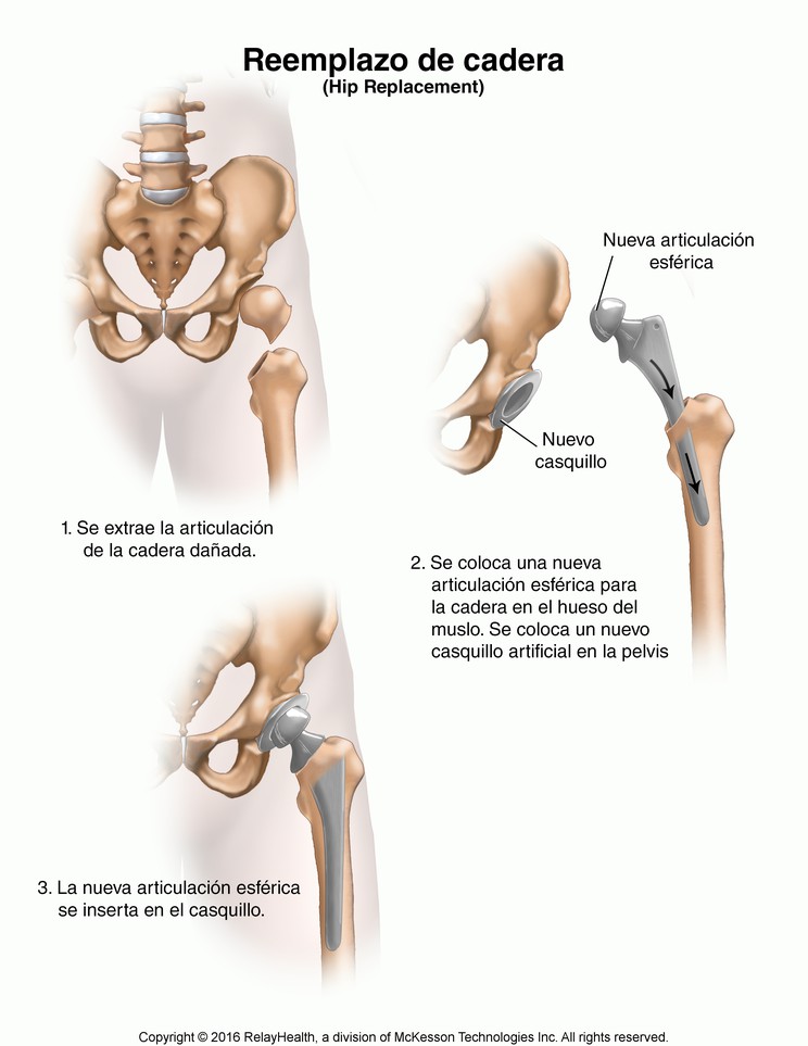 Hip Replacement: Illustration