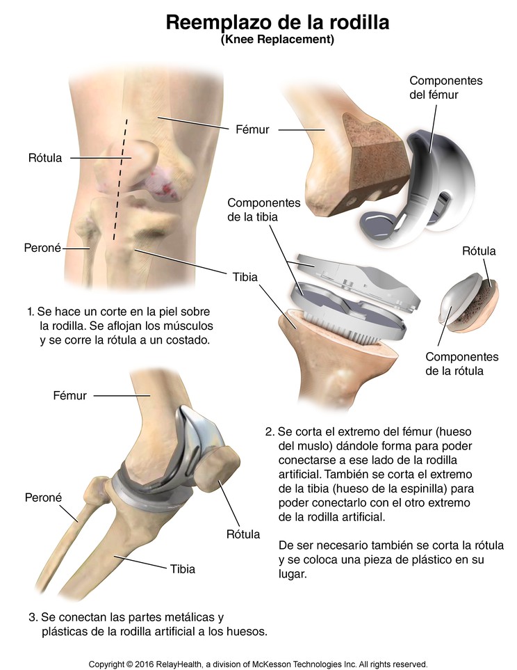 Knee Replacement: Illustration