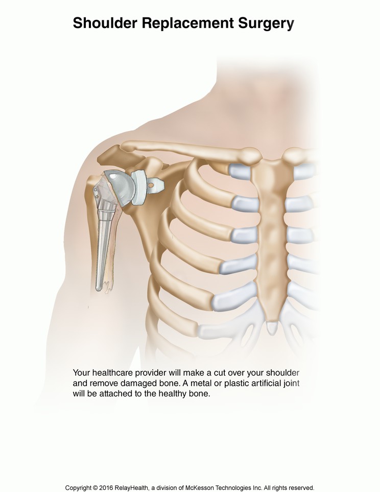 Shoulder Replacement Surgery: Illustration