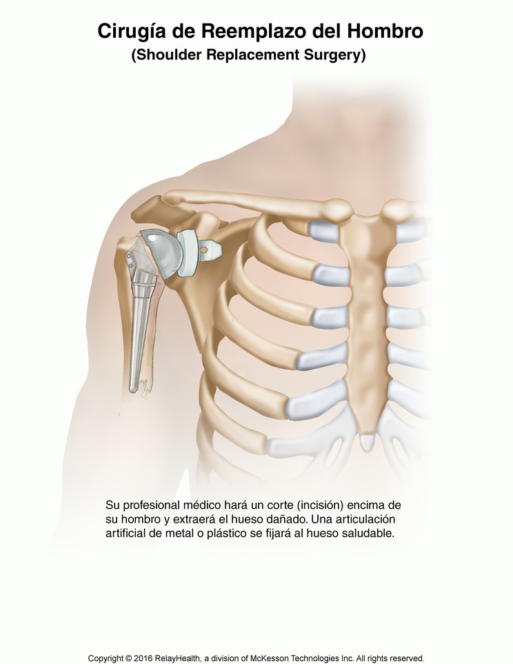 Shoulder Replacement Surgery: Illustration