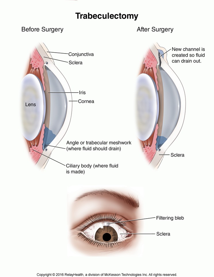 Trabeculectomy: Illustration