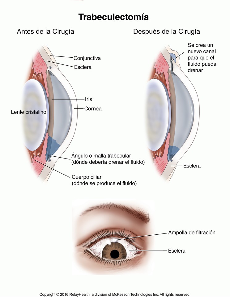 Trabeculectomy: Illustration