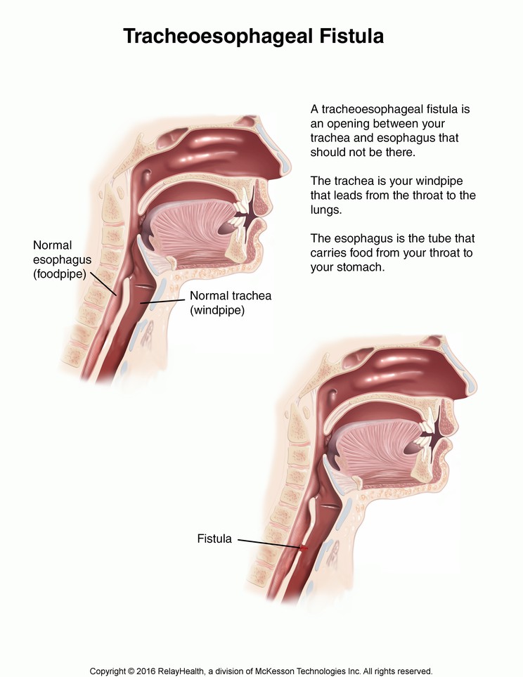Tracheoesophageal Fistula in Adults: Illustration