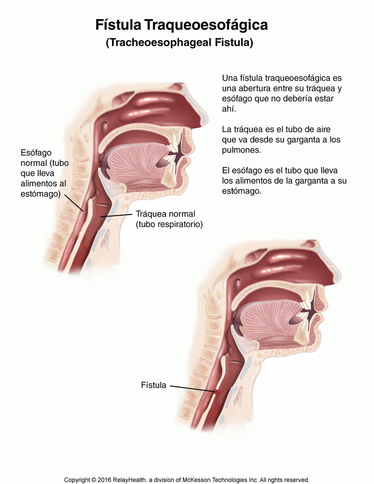 Tracheoesophageal Fistula in Adults: Illustration