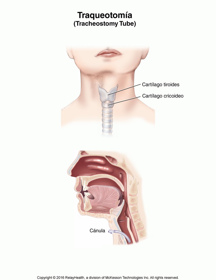 Tracheostomy Tube: Illustration