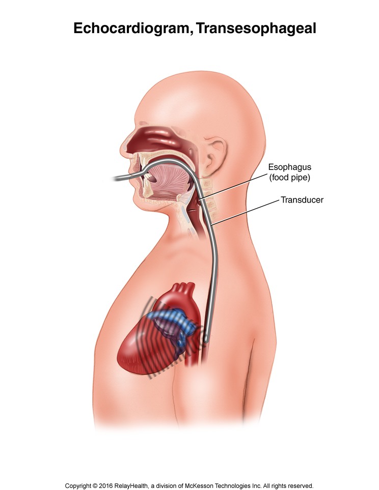 Echocardiogram, Transesophageal: Illustration