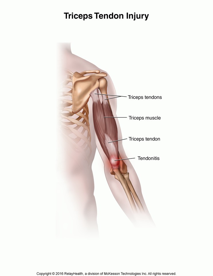 Triceps Tendon Injury: Illustration