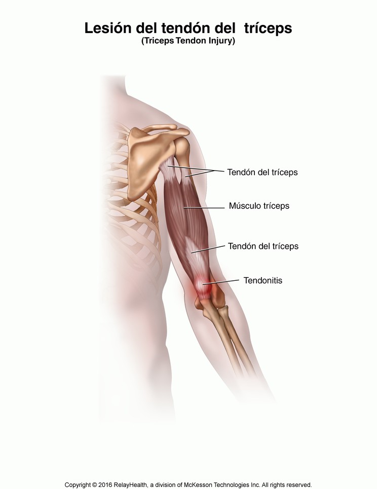 Triceps Tendon Injury: Illustration