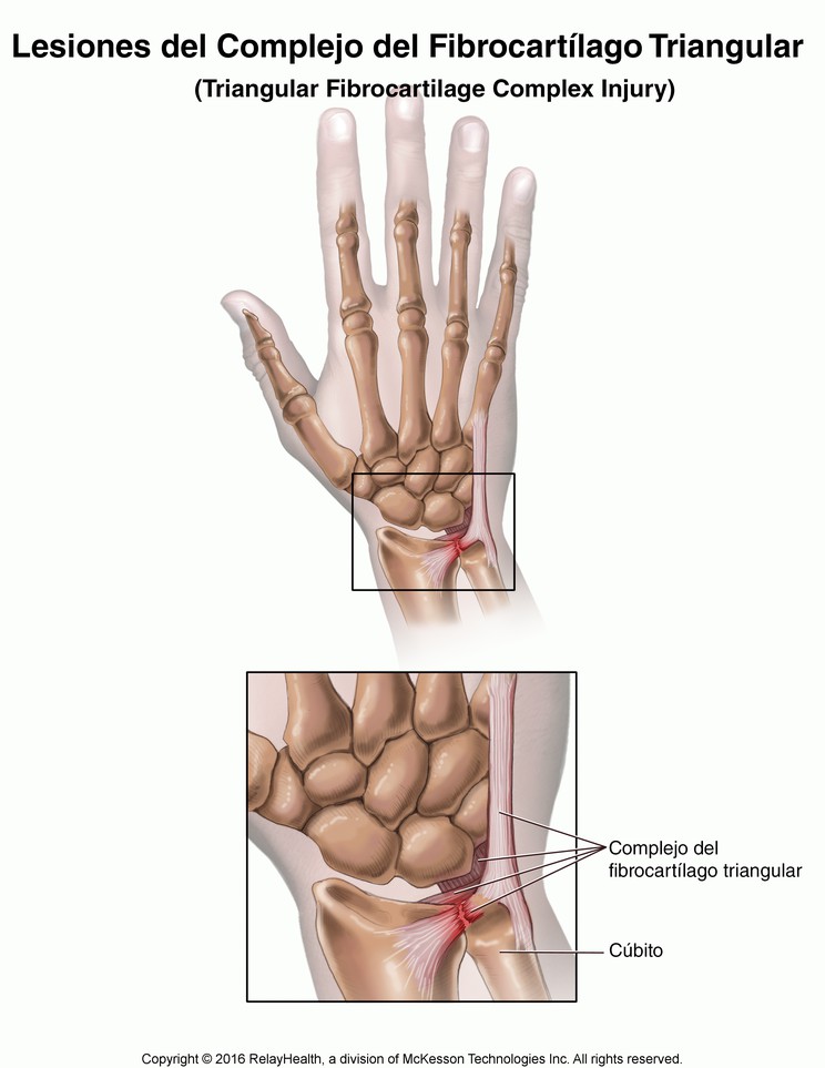 Triangular Fibrocartilage Complex (TFCC) Injury: Illustration