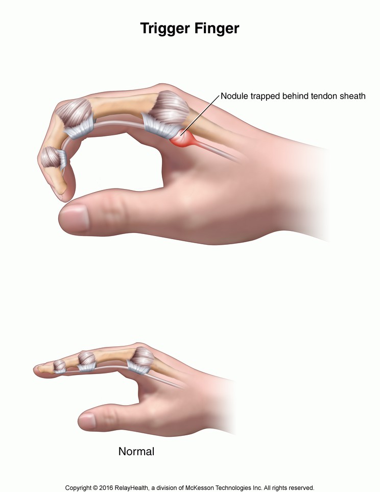 Trigger Finger: Illustration