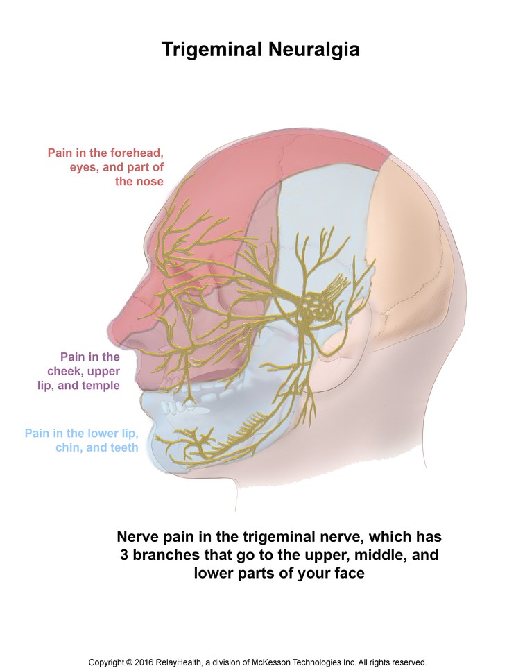 Trigeminal Neuralgia: Illustration