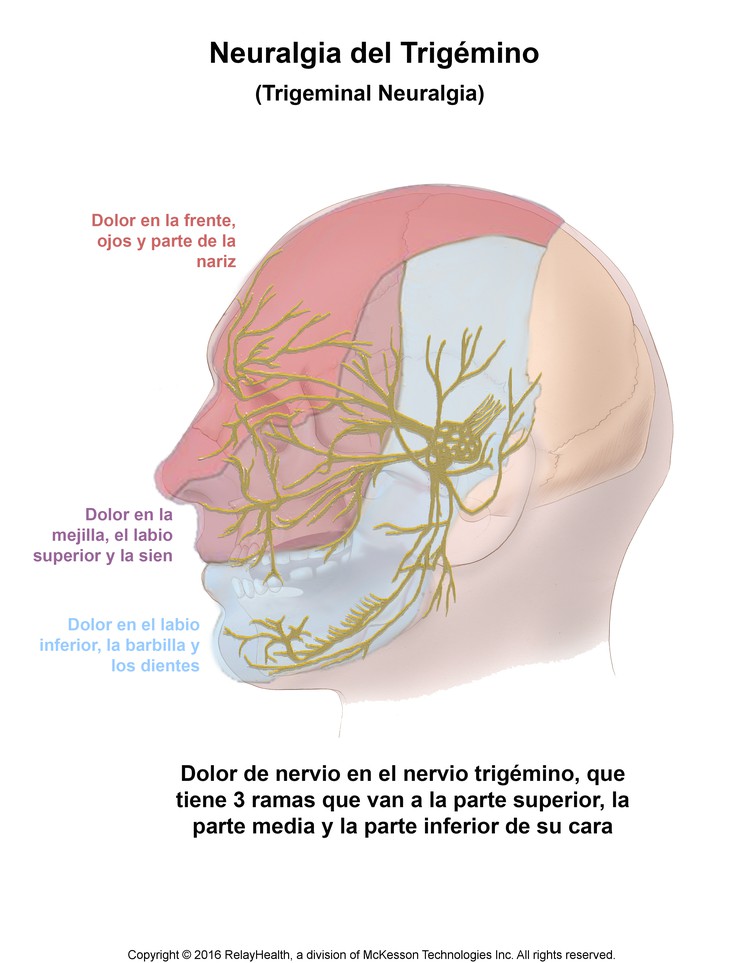 Trigeminal Neuralgia: Illustration