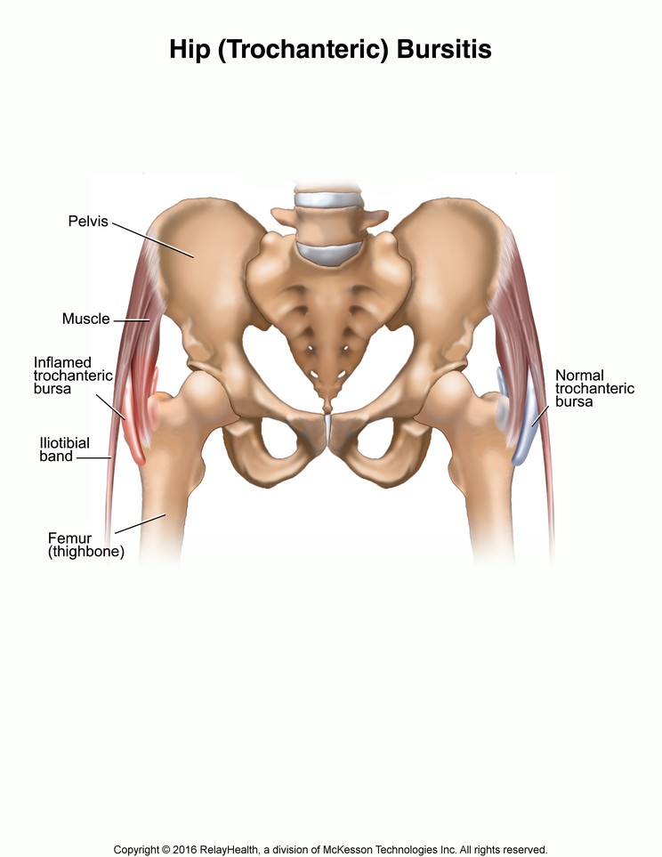 Hip (Trochanteric) Bursitis: Illustration