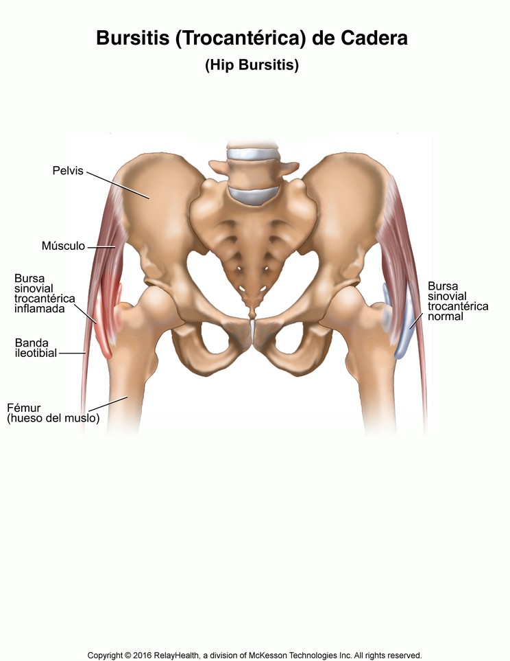 Hip (Trochanteric) Bursitis: Illustration