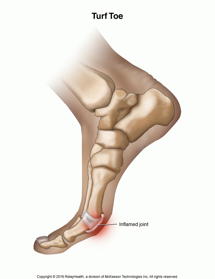 Turf Toe: Illustration