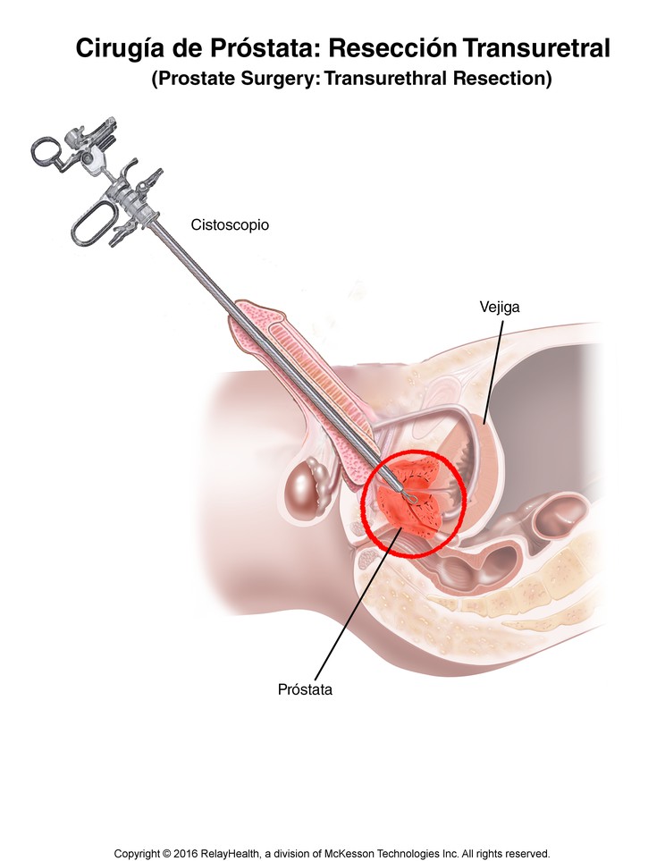 Prostate Surgery: Transurethral Resection (TURP): Illustration