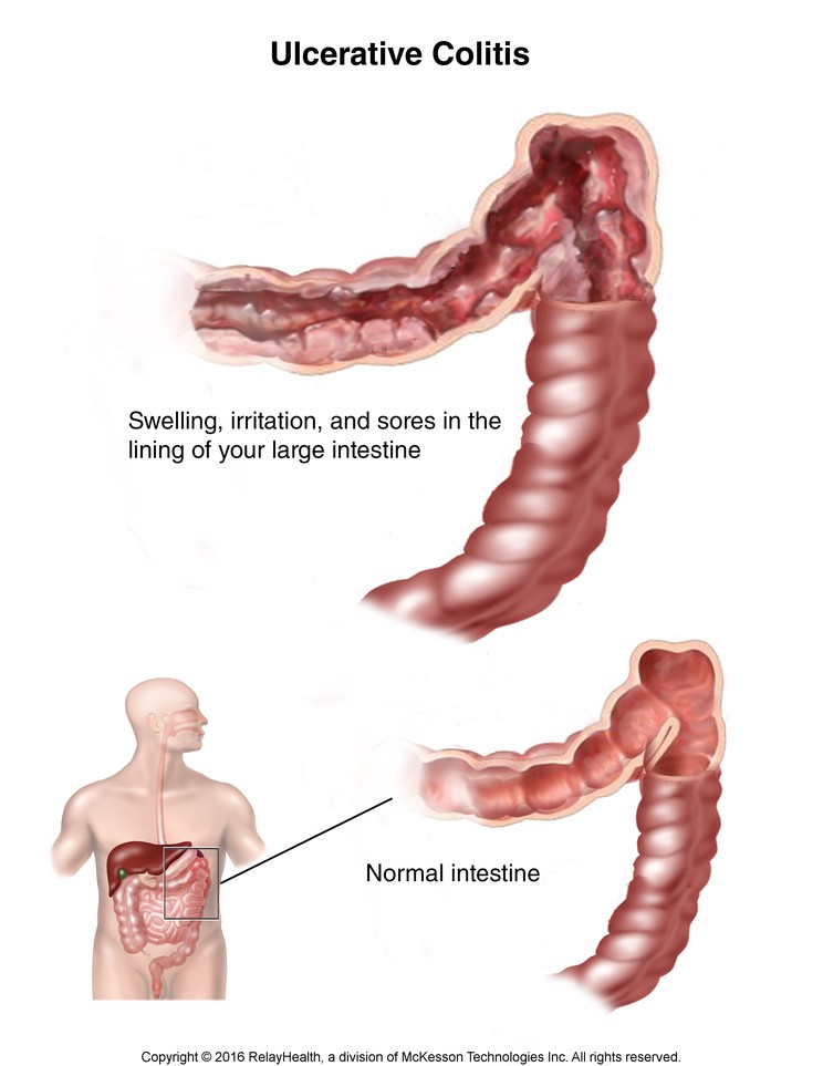 Ulcerative Colitis: Illustration