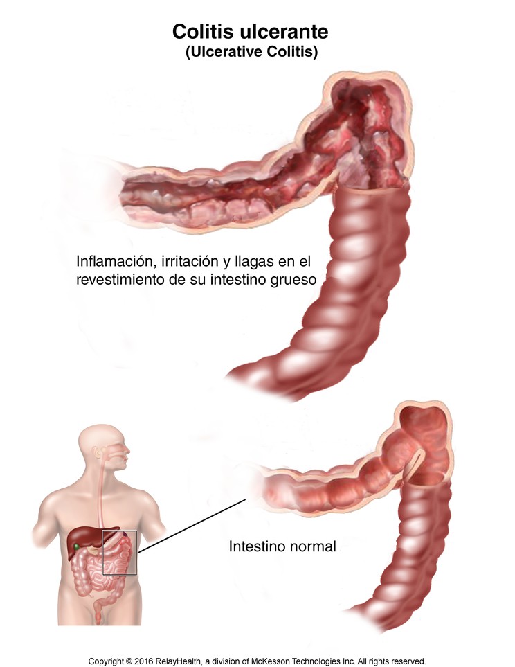 Ulcerative Colitis: Illustration