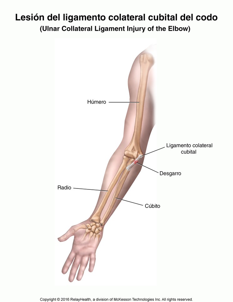 Ulnar Collateral Ligament Injury of the Elbow: Illustration